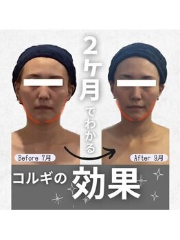 小顔フェイスラボ 難波店(小顔 Face Labo)/【2カ月で小顔】