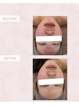 ルミナ(LUMINA)/光ハリつやケア+ニキビケア