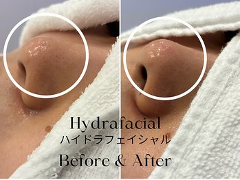 トウキョウビューティーラボ(TOKYO BEAUTY LABO.)/ハイドラBefore&After