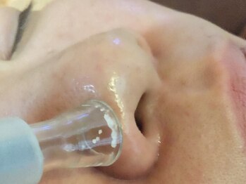 リーベ(Liebe)/毛穴洗浄(吸引・スクラバー)