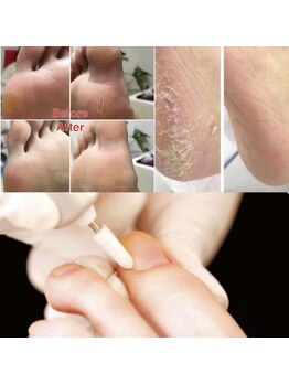 ウォーク(Walk)/足全体のケア(タコも含む)