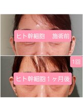 エルアンドエス(L&S)/ヒト幹細胞で目の下のたるみ改善