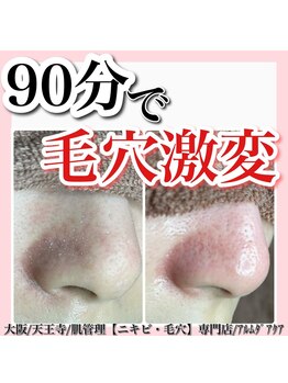 アルムダアクア 天王寺店(Aleumda AQUA)/ハーブピーリング/大阪/天王寺