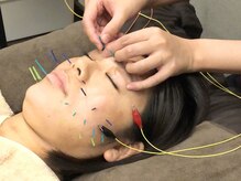ヴィゴラス鍼灸接骨院(VIGOROUS鍼灸接骨院)/美容鍼