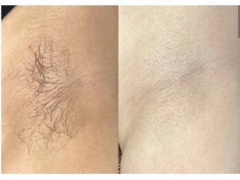 ルルトウキョウ 池袋店(LULU.tokyo)/わき脱毛/1回目→4回目