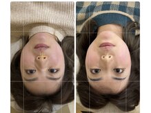 リープラス 赤坂(Re-plus)/美容鍼《小顔・リフトアップ》