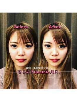きらめき ワンライフ 川口(One Life)/小顔矯正BeforeAfter7