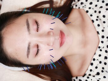 ミエリア美容鍼灸院(mielia美容鍼灸院)/mieliaリフト施術例