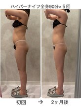 レイ(Ray)/ハイパーナイフ全身90分×５回