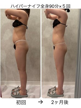 レイ(Ray)/ハイパーナイフ全身90分×5回