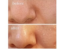 ジーニー(Genie)/リベル　ハーブピーリング