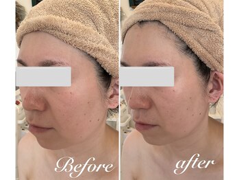 美バストアルファ(美bust α)/【小顔コルギ&バストアップ】