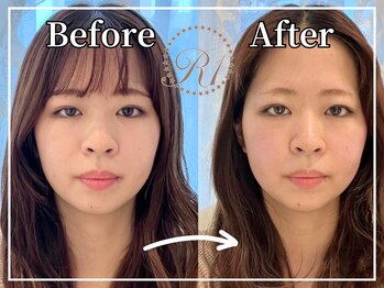 R-1ビューティーサロン 銀座/BEFORE＆AFTER　1回目