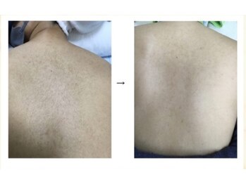 ルルトウキョウ 池袋店(LULU.tokyo)/背中脱毛/1回目→6回目