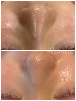 エルール トータルビューティ(Aileure total beauty)/最先端のVOSハーブピーリング