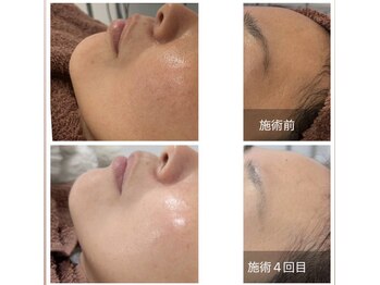 リアン/テラボーラーお肌の変化実感例