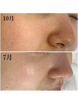 プラセル(Placer)/赤みはお肌のSOS/毛穴/札幌/北区