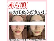 アルムダアクア 天王寺店(Aleumda AQUA)/ハーブピーリング/大阪/天王寺