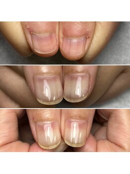 爪を噛む癖とむしり癖