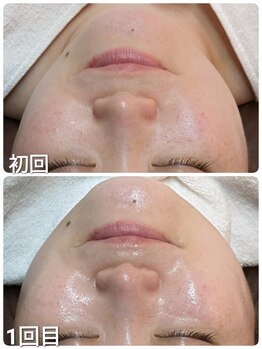 ウララ(ulala)/ララピール1回目