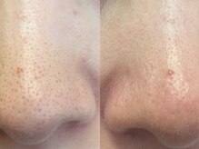 シロ(CHILO)/ハイドラ　before　after３