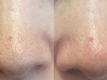 シロ(CHILO)/ハイドラ　before　after３