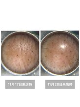 雪中花ナルシサス(narcisse)/眉間のしわ、施術前→施術後10日