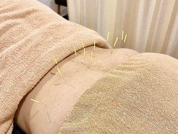 アカシア鍼灸整骨院/腰部の鍼