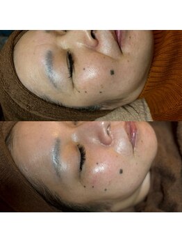 リラクゼーションネイルサロンリキリキ(Relaxation Liki Liki)/ハーブピーリング