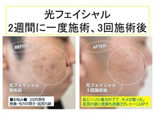 猫の手/細胞を活性化☆光フェイシャル
