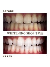 ホワイトニングショップ 千葉店/歯科提携　ホワイトニング専門店