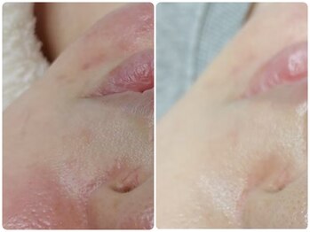 イデアルミー 大宮店(イデアルMe)/ララピールbefore after 8回目