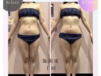 ルピナス ヒサヤ(LUPINUS hisaya)/Vシェイプ痩身