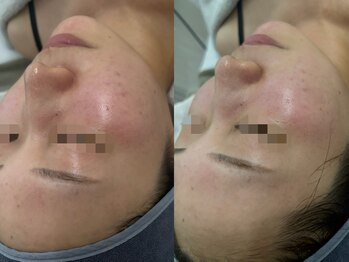 ファーファラ(Farfalla)/ハーブピーリング