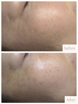 ユニ(uni.)/ハーブピーリング症例