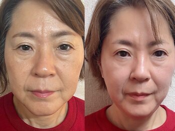 ハーツイーズの写真/たるみは年齢ではなく「巡りの低下」かも？オールハンド施術で一人一人の状態に合わせお悩みを改善♪