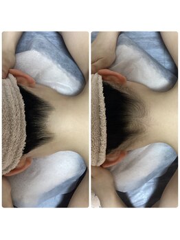 ［脱毛専門・肌育サロン］LULU.tokyo池袋2nd店/うなじ脱毛