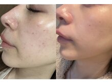 セルヴィノバ(CELL VI NOVA)/＊ビフォーアフター