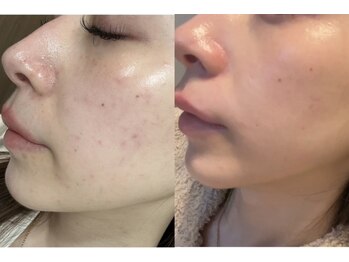 セルヴィノバ(CELL VI NOVA)/＊ビフォーアフター