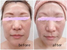 Beauty salon CENDRILLON【サンドリヨン】/最強小顔フェイシャル