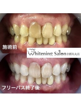 ホワイトニングサロン 京都烏丸店/ホワイトニング施術例