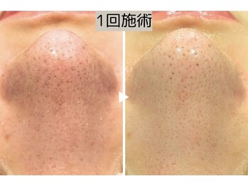 ロワ(Roi)/【ハイドラ毛穴洗浄】1回施術