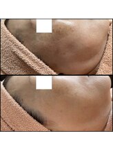 リッツ 大宮店/【Before/After】シミ改善