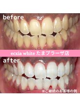 エクシアホワイトニング たまプラーザ店/ビフォーアフター