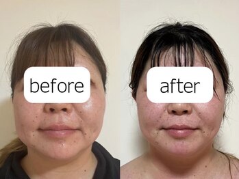 ヨサパーク ベル(YOSA PARK Belle)/リフトアップ効果も！