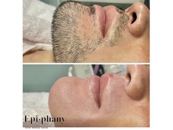 エピファニー(Epi phany Total Beauty Salon)/髭ワックス脱毛/青ヒゲおさらば