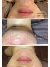 【ニキビケア】大人気★顔脱毛×肌質改善ピーリング！トラブルを防ぐ美白導入＋パックで贅沢ケア