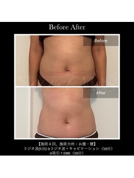 パルファンドゥー(parfum doux)/痩身【お腹】ビフォーアフター