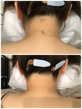 ビープラス(B plus)/効果長持ちうなじMIX脱毛☆