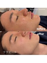 ムーンストーン(Moonstone)/ララピール　ビフォーアフター